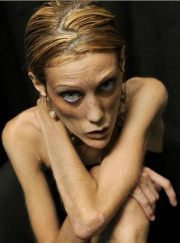 anorexic models